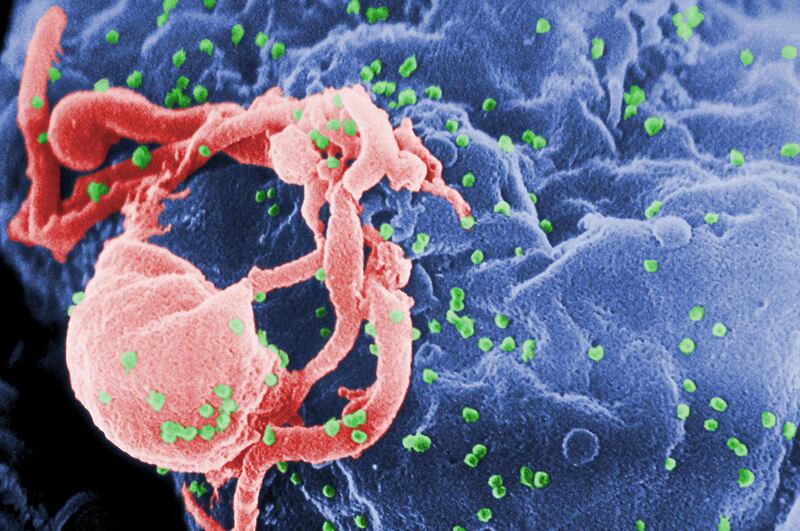 This undated photo provided by the Centers for Disease Control and Prevention shows a scanning electron micrograph of multiple round bumps of the HIV-1 virus on a cell surface. An 18-year-old French woman born with the AIDS virus has had her infection und