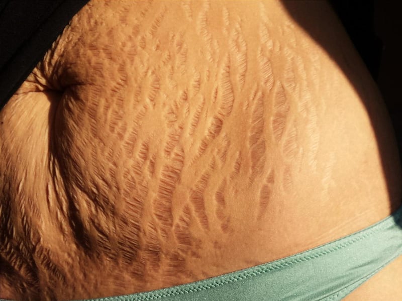 This undated self-portrait image released by Canadian student Karly Vedan, shows stretch marks along her stomach. An Instagram campaign started months ago by moms Alex Elle, a writer, and Erika Layne Salazar, a photographer, dubbed Love Your Lines urges