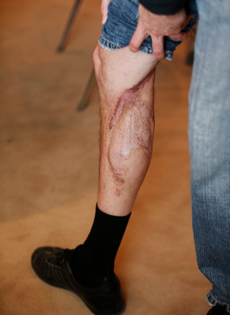 Bad Brad Wheeler, 99.9 KUAA's new program director, shows his recovering leg in Salt Lake City on Mar 29, 2018. 99.9 KUAA is owned by the Utah Arts Alliance.