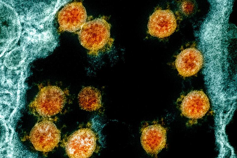 Coronavirus SARS-CoV-2 virus particles, orange, isolated from a patient.
