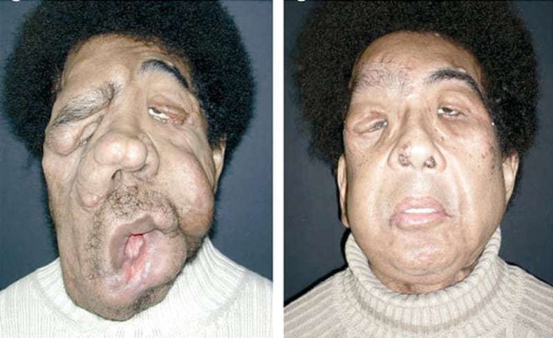 Unidentified man with tumors, far left, received a transplanted new lower face from a donor. Six months later he could smile.