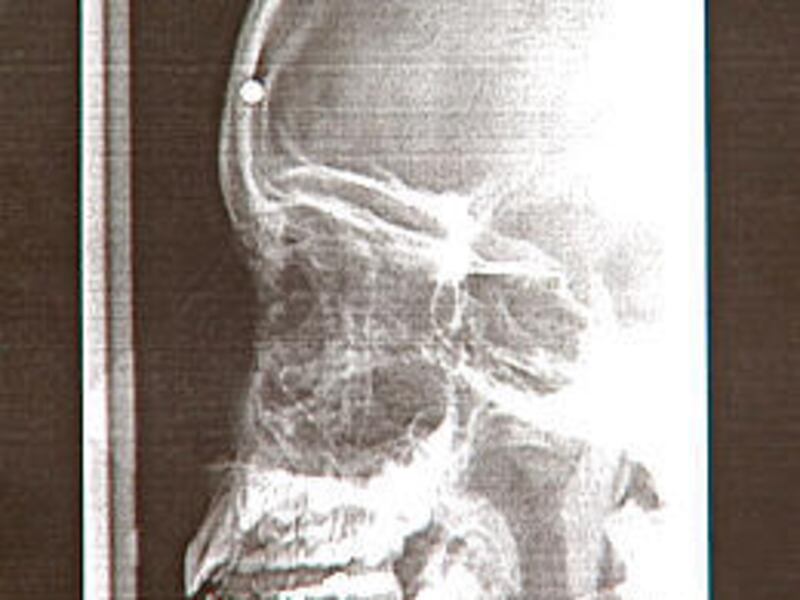 A BB shows up in this image of the skull of a 10-year-old who says an 18-year-old boy shot him Tuesday with a BB rifle.