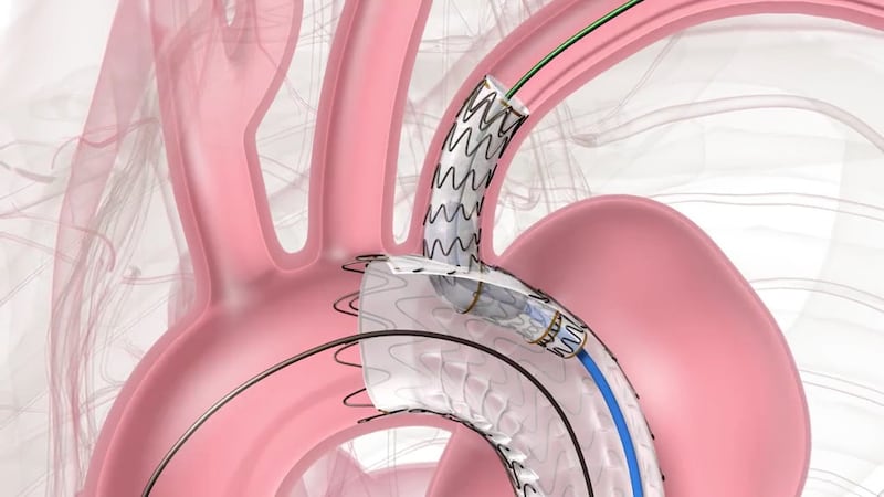 A graphic shows a thoracic branch endoprosthesis in place in the aortic arch of the heart.