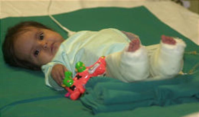 Milagros Cerron rests the day after surgery to separate her fused legs.