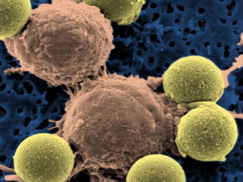 This microscopy image provided by Dr. Carl June on Wednesday, Aug. 10, 2011 shows immune system T-cells, center, binding to beads which cause the cells to divide. The beads, depicted in yellow, are later removed, leaving pure T-cells which are then ready