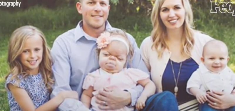 Brielle Burr, who is now 4 years old, was born with Beare Stevenson Syndrome, which causes premature fusing of the skull.