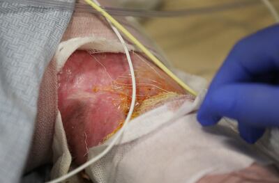 Burn victim Austin Weaver undergoes physical therapy at University of Utah Health's Burn Center in Salt Lake City on Friday, July 20, 2018. Weaver's family says his life has essentially been saved by a new burn treatment substance called SkinTE.