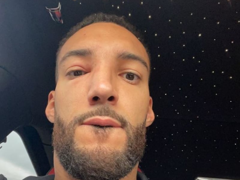 Utah Jazz center Rudy Gobert after he was stung by a bee on Thursday, April 28. 2022.