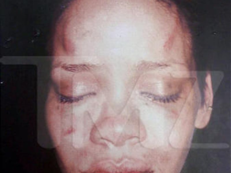 This undated photo provided by TMZ of pop star Rihanna was according to TMZ, "taken after Chris Brown allegedly beat her." Rihanna was reportedly involved in a domestic dispute with boyfriend Chris Brown last week that resulted in his arrest and booking o