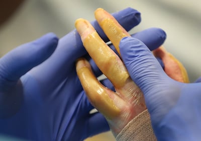 Burn victim Austin Weaver's fingers are during physical therapy at University of Utah Health's Burn Center in Salt Lake City on Friday, July 20, 2018. Weaver's family says his life has essentially been saved by a new burn treatment substance called SkinTE