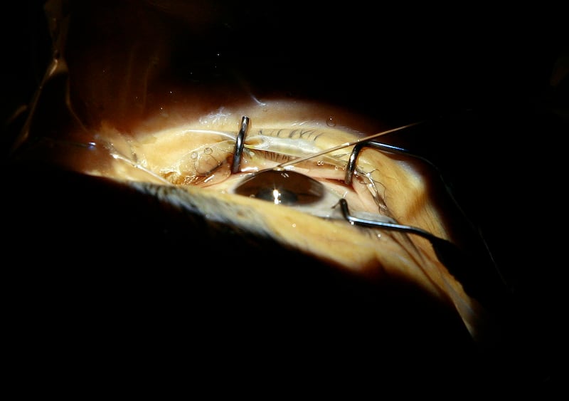A double cataract eye surgery is performed during a free eye care surgery event at the Moran Eye Center in Salt Lake City.