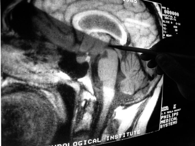 An image of a human brain is studied on a video screen.