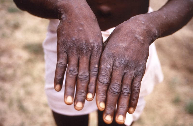 The Centers for Disease Control and Prevention investigated a monkeypox outbreak the the Democratic Republic of the Congo.