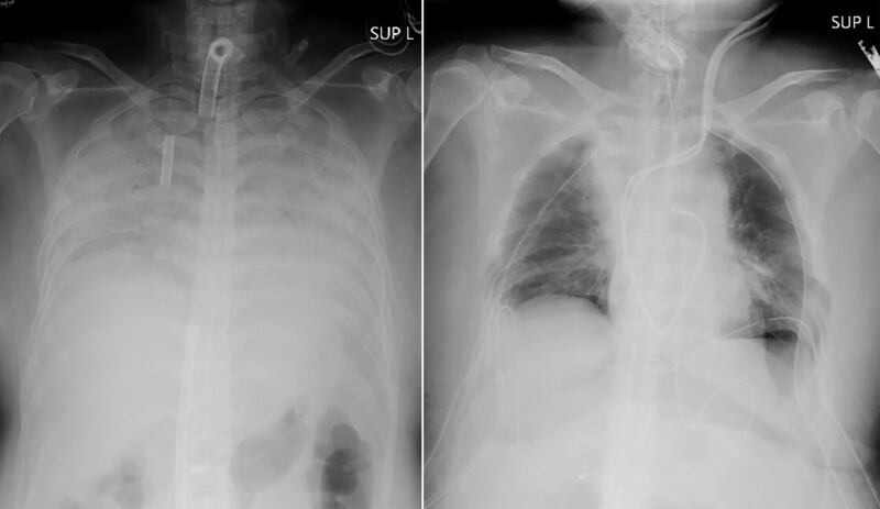 This combination of radiographs provided on April 9, 2021, by Kyoto University Hospital, shows the chest of a patient before the surgery, left, and after the surgery, right.