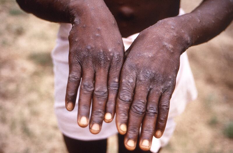As more cases of monkeypox are detected in Europe and North America in 2022, some scientists who have monitored numerous outbreaks in Africa say they are baffled by the unusual disease’s spread in developed countries.