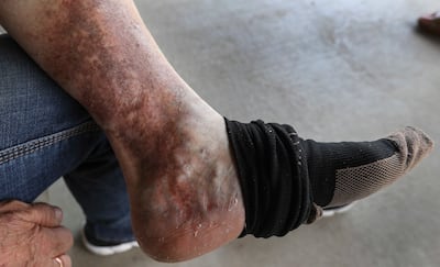 Bonnie Christensen’s leg, pictured on Wednesday, June 26, 2019, is almost back to normal after bumping it on a hay cart on her farm in Salt Lake City. Following the bump her leg wouldn’t heal and she finally found out she has a common condition called chr