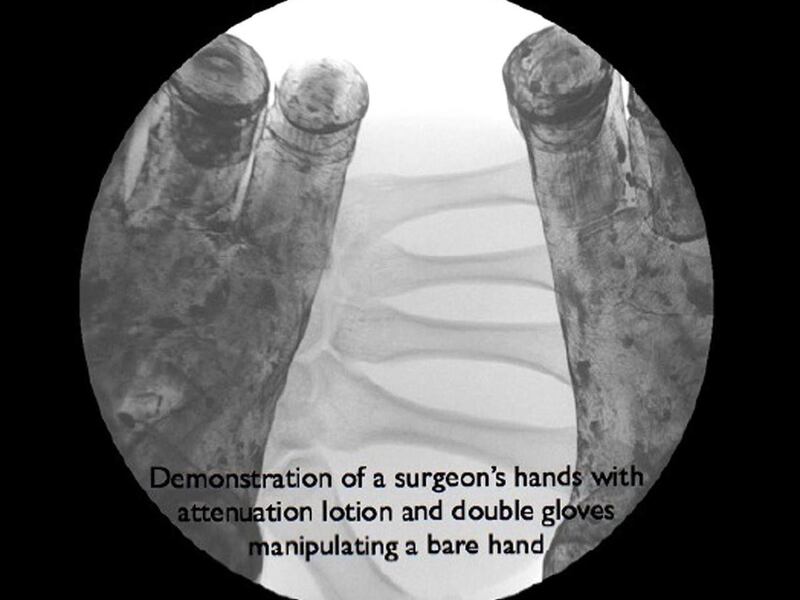 X-ray of surgeon hands coated with BloXR lotion and wearing double latex gloves manipulating a bare hand.