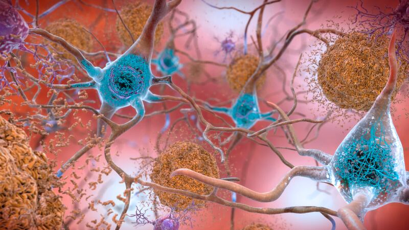 Cells in an Alzheimer’s affected brain, with abnormal levels of the beta-amyloid protein clumping together to form brown plaques that collect between neurons and disrupt cell function.