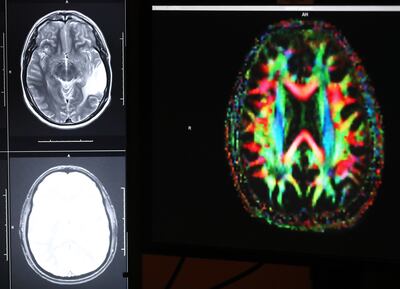An MRI image of a brain is pictured at the Imaging and Neurosciences Center in Salt Lake City on Friday, Dec. 28, 2018. U. researchers found MRI scans of patients who have Alzheimer's disease show that playing songs with personal meaning to them activates