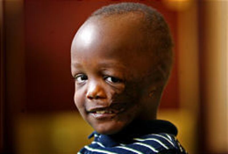 Four-year-old Daniel Wachira was abandoned as a newborn on a trash heap, where a dog mauled him.