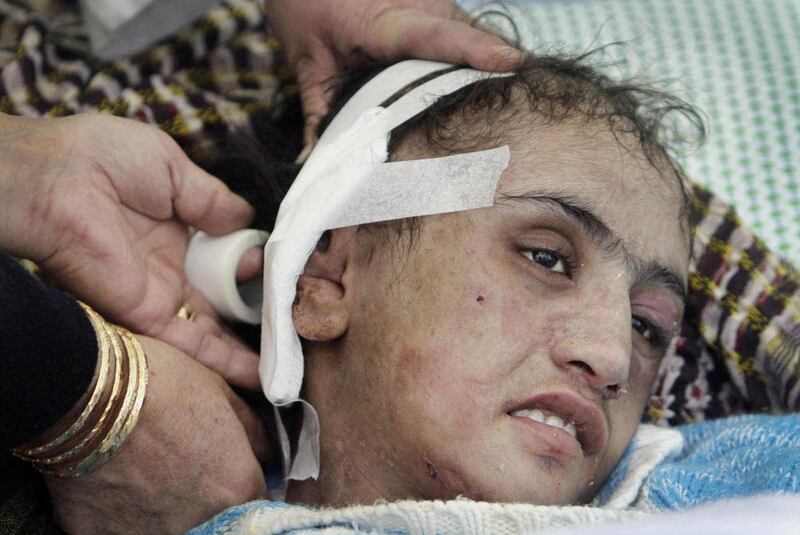 FILE- In this Saturday, Jan. 7, 2012 file photo, Afghan doctors, unseen, dress the tortured ear of Sahar Gul, 15-year-old at a hospital in Kabul, Afghanistan. The in-laws of a child bride who became the bruised and bloodied face of women's rights in Afgha