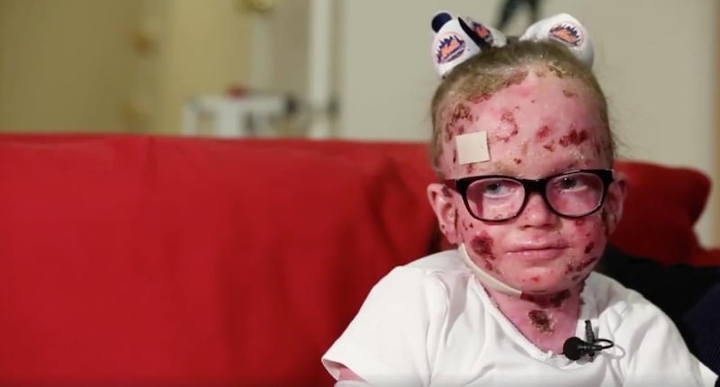 Ella Murray tells the Washington Post about Epidermolysis Bullosa (EB), a rare skin disease that she was born with.