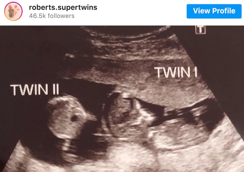 A woman got pregnant while she was already pregnant. She gave birth to twins.
