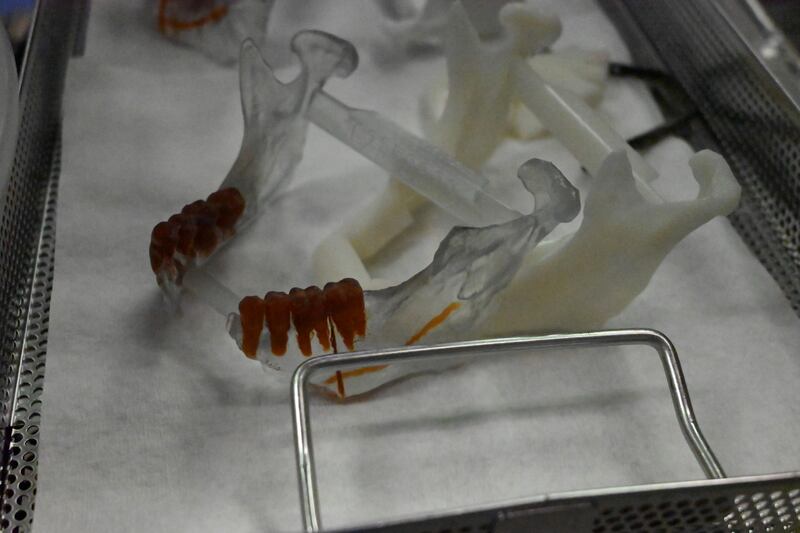 Model jaws prepared for Rudy Noorlander. These models were used to help construct a new jaw for Noorlander with the fibula bone in his leg.